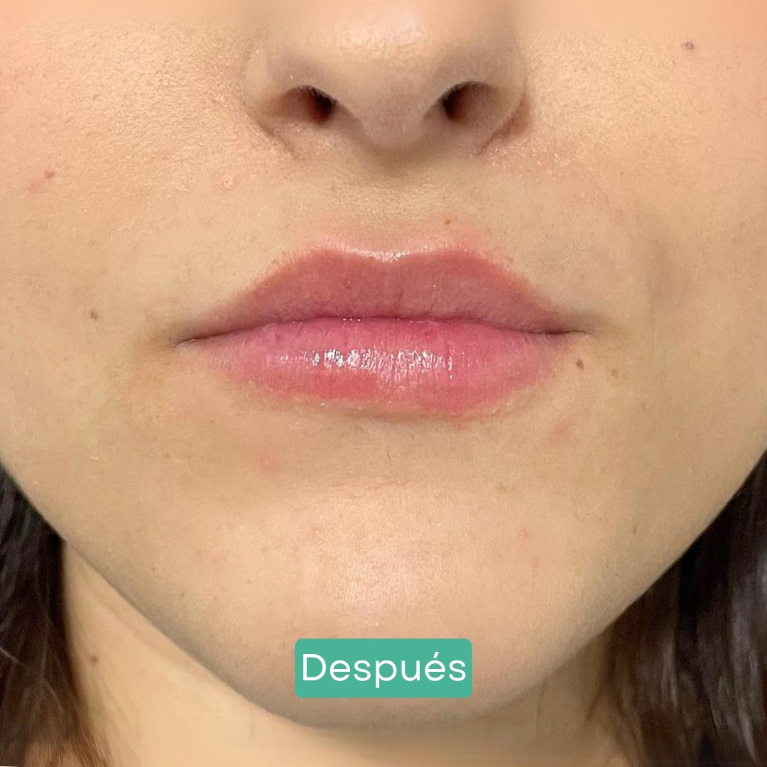 despues aumento labios covelli