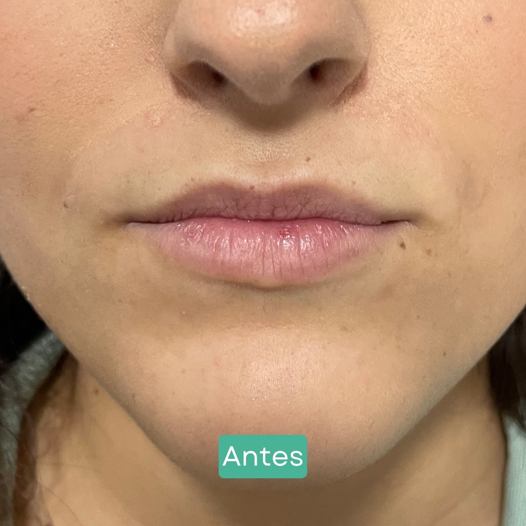 Antes-5 covelli aumento labios