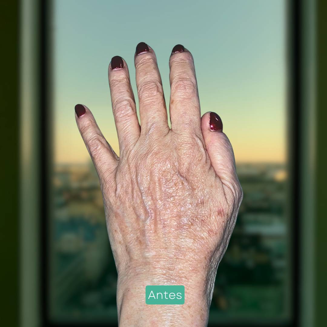 eliminacion manchas manos y cara en barcelona eliminacion manchas manos y cara en barcelona