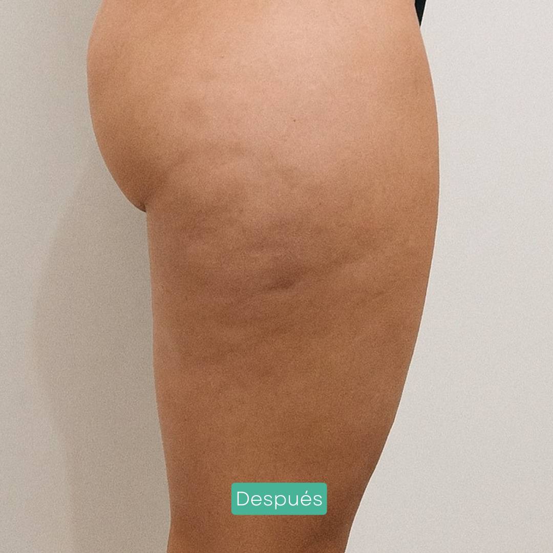 mesoterapia corporal eliminación celulitis y grasa localizada en barcelona 2