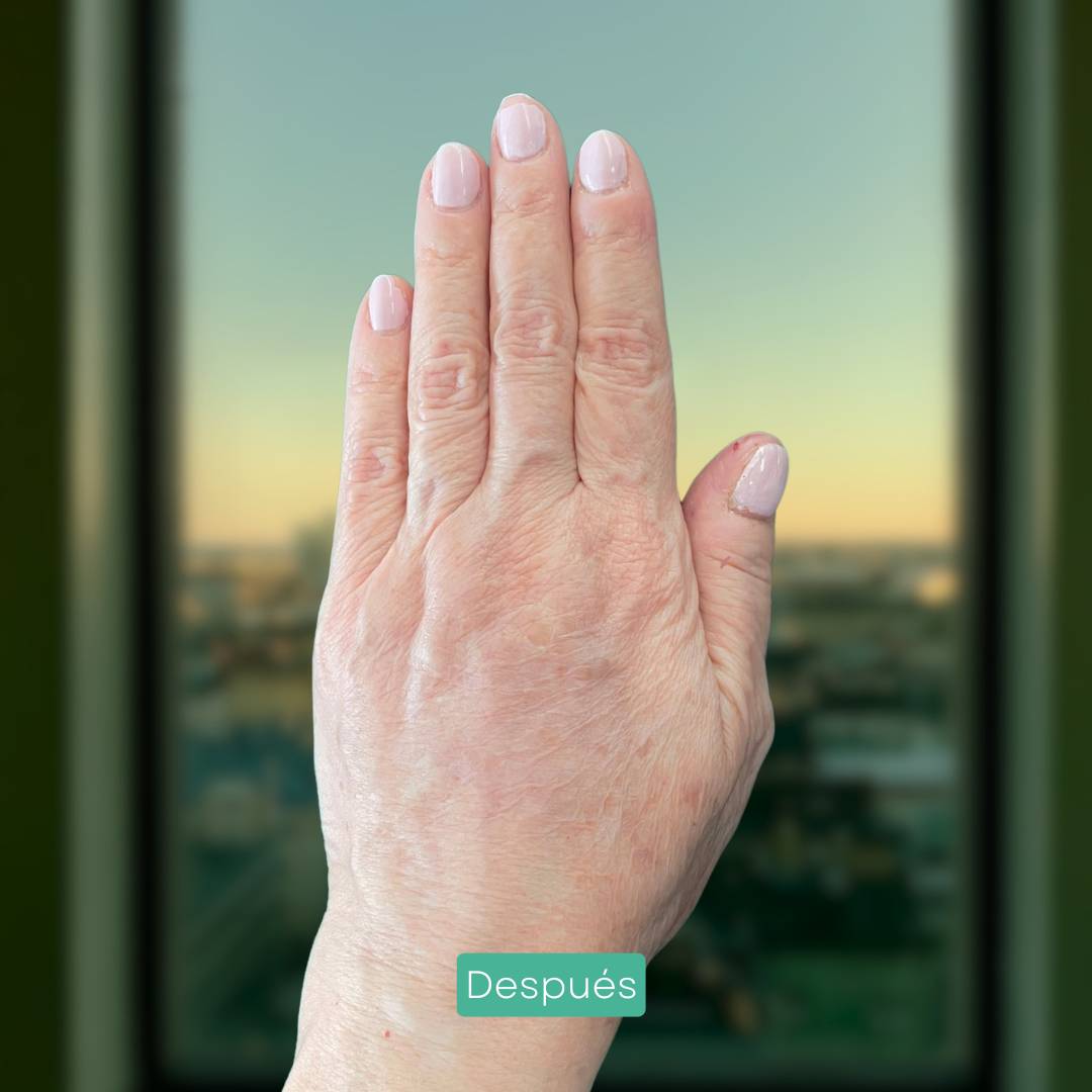 eliminacion manchas manos y cara en barcelona