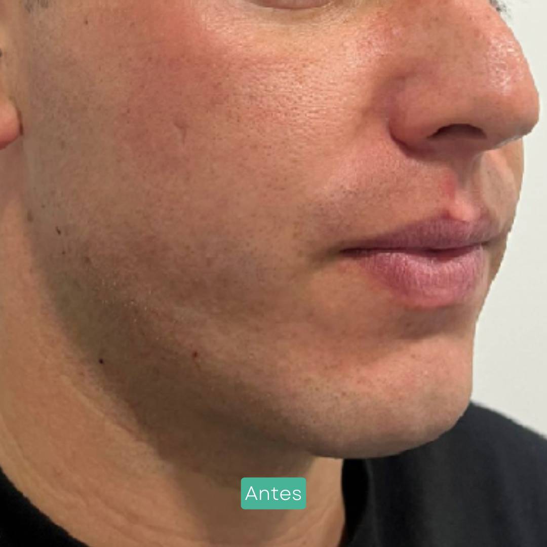 masculinización facial en barcelona marcaje mandíbula masculinización facial en barcelona marcaje mandíbula