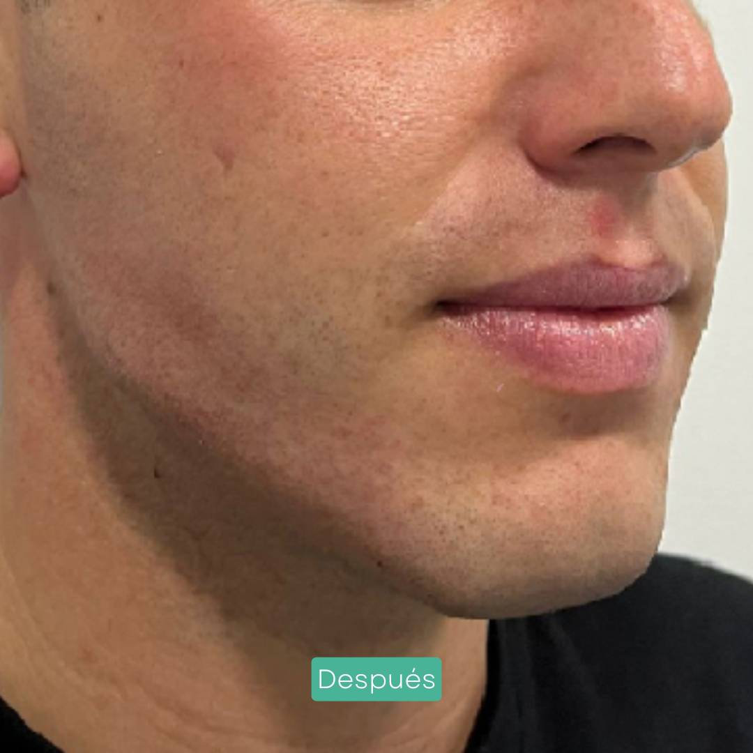 masculinización facial en barcelona marcaje mandíbula 2