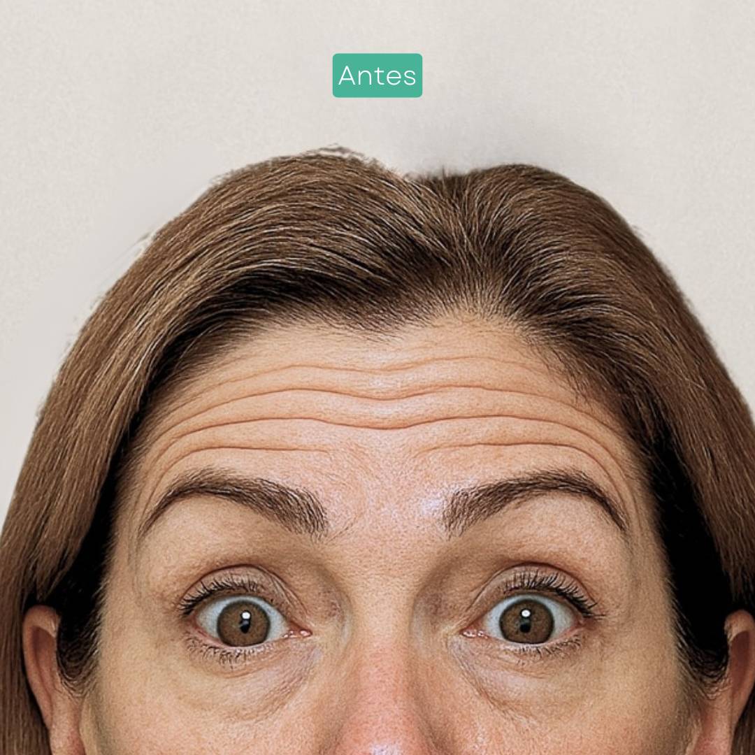 7 neuromoduladores estética barcelona