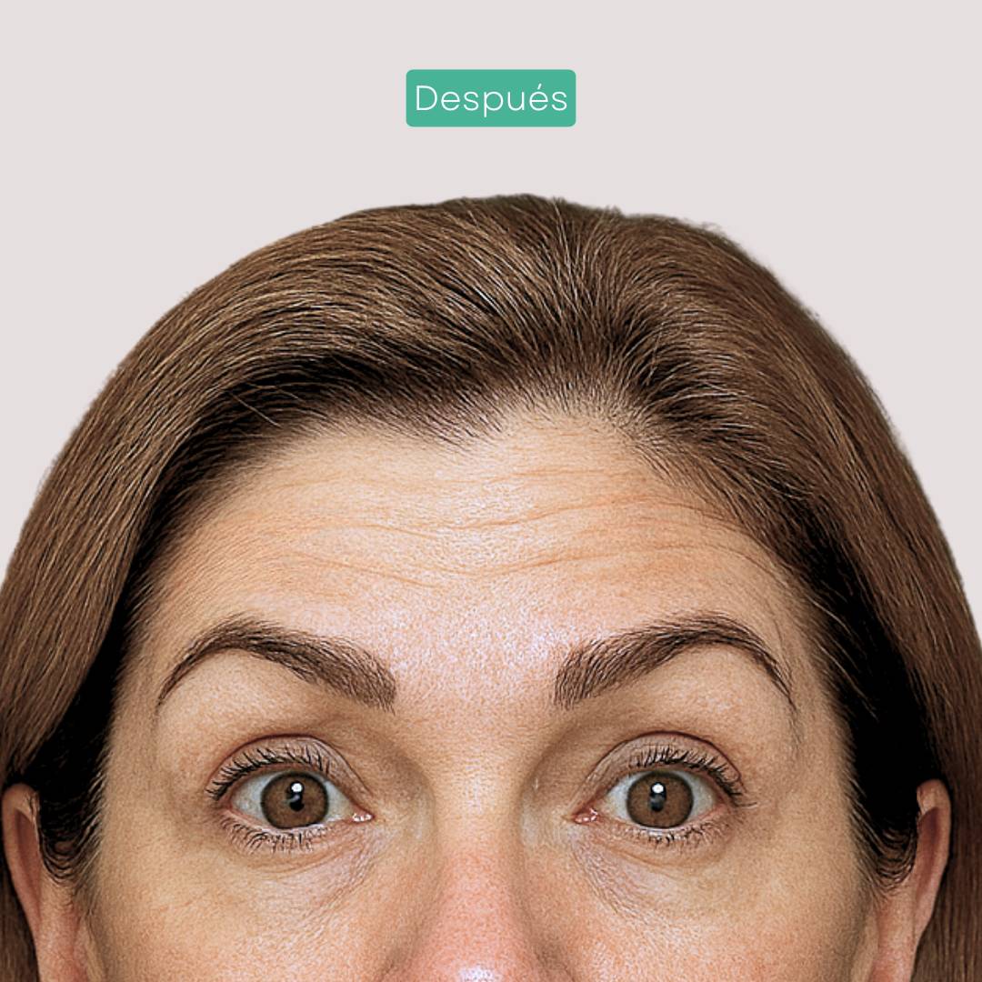 neuromoduladores estética barcelona 2