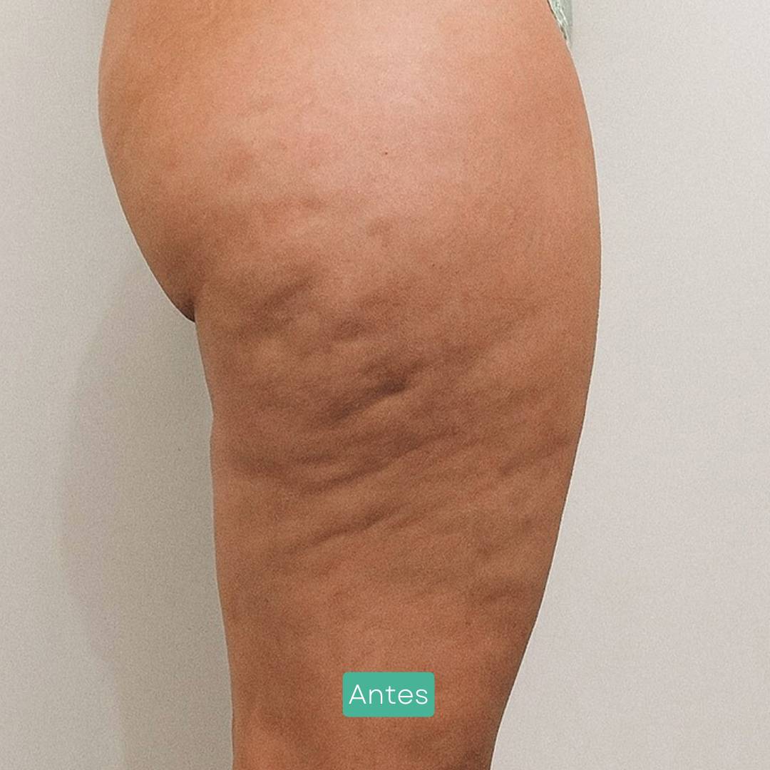 9 mesoterapia corporal eliminación celulitis y grasa localizada en barcelona
