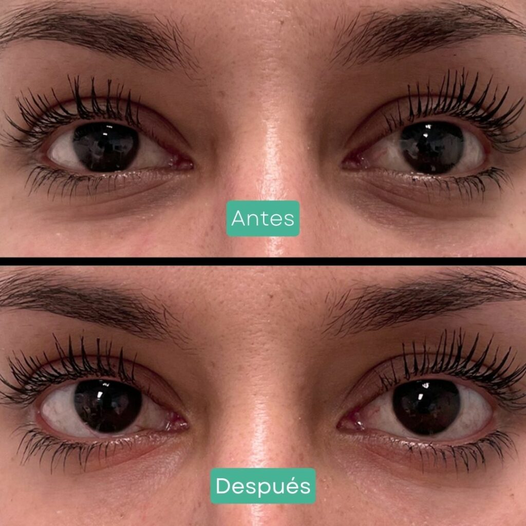 tratamiento ojeras barcelona dra covelli